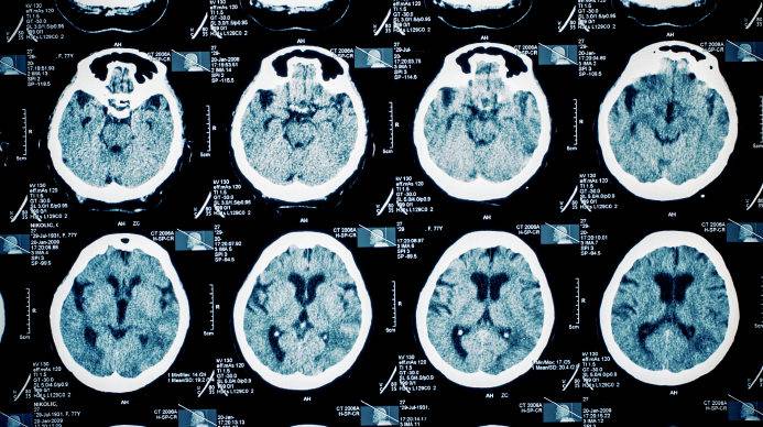 Scientists reveal breakthrough in motor neurone disease